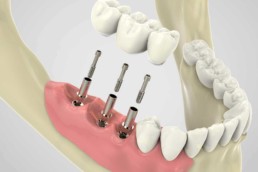 instituto-braga-de-odontologia-e-pesquisa-instituto-ibop-dentistas-curso-carga-imediata-2019