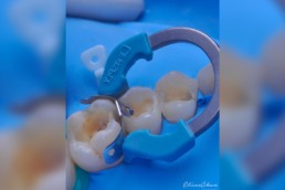 institutoibop-ibop-cursos-odontologia-sao-paulo-blog-Consideracoes-que- determinam-a-selecao-da-tecnica-restauradora-em-dentes-posteriores-dr-eliseo-chun