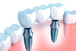 instituto-braga-de-odontologia-e-pesquisa-instituto-ibop-dentistas-curso-protese-sobre-implante-2019